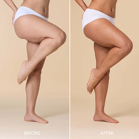 Image 1 - A side-by-side comparison showing a womans leg posture with the left labeled Before and the right labeled After, demonstrating a change in appearance.