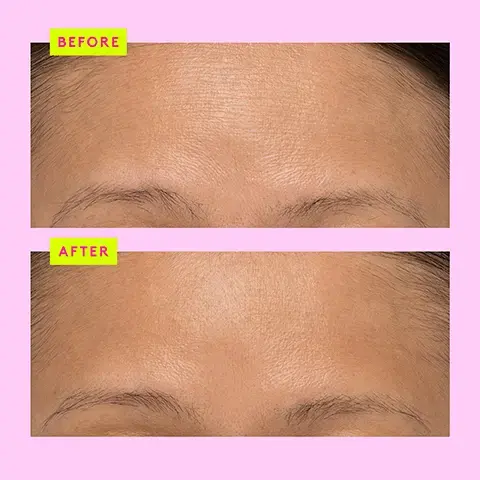 Image 1, BEFORE AFTER Image 2, T.L.C. FramboosTM AHA blend Resurfaces and exfoliates skin for a smoother, more even-looking complexion. Salicylic acid (BHA) Loosens sebum to unclog pores while soothing skin. TLC. Framboos" Gyvele Night Serum Sérum de mult Bolique Raspberry fruit extract Rehydrates and soothes skin; fights free radicals with antioxidants. xx AAA Extr xx Image 3, face off serum edition T L C glycolic serum key ingredients 10% AHA and 1% BHA perfect for anyone looking for a powerful nightly exfoliant to resurface and improve the look of skins tone and texture fine lines and pores c firma fresh day serum key ingredients 15% l ascorbic acid and ferulic acid perfect for anyone looking to brighten uneven tone and firm skin and wants the freshest vitamin C around protini powerpeptide resurf serum key ingredients 10%b lactic acid and 11 signal peptides perfect for anyone looking for gentle AHA exfoliant with a shot of peptides to achieve plump smooth and radiant skin Image 4, T.L.C. ❤s F-Balm Use T.L.C. Framboos for a gentle chemical exfoliation that clears the way for maximum absorption of F-Balm. Step 1 Apply 1 pump T.L.C. Framboos for gentle chemical exfoliation or your favorite p.m. skincare smoothie. Step 2 Top it off with 4-5 pumps of F-Balm to plump and restore. Step 3 Lights out. TLC X + Top it off! F-Balm" Electrolyte Waterfacial Masque hydratant Image 5, oh what a night smoothie for smoother, hydrated, radiant skin 1 PUMP Lala Retro 1 PUMP T.L.C. Framboos 1 PUMP B-Hydra Mix it all together and apply.