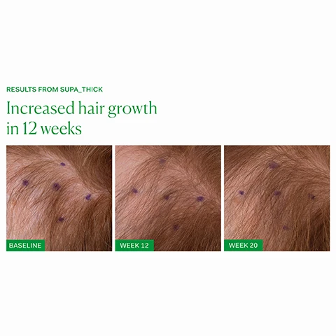 image 1, results from supa_thick. increased hair growth in 12 weeks. baseline, week 12 and week 20. image 2, increased hair growth in 12 weeks. before and after. image 3, 92% agree hair looks thicker. 93% agree they have less hair shedding. 95% noticed an improvement in hair quality. after 3 months of use. consumer panel conducted by the nue co with 40 respondents. image 4, treat hair loss. inner growth phase - women looking to address hair shedding and support new hair growth. clinically proven to increase hair growth and reduce breakage. three capsules daily with food. outer supa thick scalp serum - anyone looking to address hair shedding and support new hair growth. before washing, divide hair into sections, apply directly to scalp and massage in. leave for 20 minutes and then wash hair as normal. image 5, supports scalp microbiome with clinically studied probiotics. stimulates new hair growth and reduces shedding. clinically proven results in 60 days. image 6, old packaging vs new packaging. as our new packaging phases in sustainably, you may receive either out old or new jar and box. inside the jar it's the same formula you know and love.