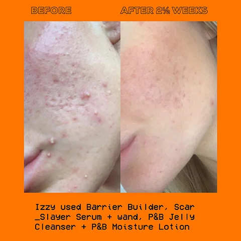 before and after 2 and half weeks. Izzy used barrier builder scar slayer serum and wand, p and b jelly cleanser and p and b moisture lotion