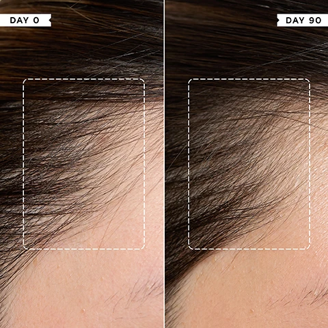 Image 1 - A side-by-side comparison shows a persons temple hairline with sparser hair on the left labeled Day 0, and significantly denser hair growth on the right labeled Day 90, both panels highlighting the hair growth area with a dashed rectangle. Image 2 - A dark green bottle with a white dropper for hair serum is shown next to text stating 81% noticed HAIR LOSS was REDUCED after 2 months* and 80% noticed an IMPROVEMENT in HAIR GROWTH after 2 months*, with the bottle label displaying PHILIP KINGSLEY DENSITY PRESERVING SCALP DROPS SERUM PROTECTEUR POUR CUIR CHEVELU, Reduces hair fall and preserves density Limite la chute de cheveux et préserve la densité capillaire 75ml 2.67 fl oz, and the disclaimer *INDEPENDENT USER TRIALS. Image 3 - A dark green bottle of Philip Kingsley Density Preserving Scalp Drops with a white dropper and three clear liquid drops is shown next to a list of benefits: KEY BENEFITS Stimulates and protects follicles to preserve hair density Creates an optimal scalp environment for healthy hair growth Helps reduce hair fall and preserve the hair you have. Image 4 - A close-up shows a dropper applying liquid to dark hair parted on a scalp, with the text CLINICALLY PROVEN to slow hair loss and reduce shedding after 3 months use* visible, and *INDEPENDENT CLINICAL TRIALS BASED ON A MINIMUM OF 3 MONTHS DAILY at the bottom, and .15 on the dropper. Image 5 - A hand holds a dropper dispensing a clear liquid onto a persons scalp with reddish-brown hair, alongside the text Trichologist Tip Consistency leads to results. Apply to the scalp DAILY to help maintain follicle health and reduce shedding over time. Image 6 - A hand holds a dark green bottle of Philip Kingsley Density Preserving Scalp Foam, and to the right, the text Key Benefits lists Weightless formula delivers thicker-looking hair, Adds texture and root lift, Creates optimal scalp environment, and Improves hair quality, shine and strength. Image 7 - A dark green bottle of Philip Kingsley Density Preserving Scalp Foam with a white cap and label is displayed next to text that reads Trichologist Tip: Start with a small amount and add more if needed. For maximum root lift, blow dry hair using a radial brush or tip your head upside down while drying. The bottle label also says Mousse Protectrice Pour Cuir Chevelu, Adds texture and root lift, Ajoute de la texture et du volume aux racines, 120ml, 4.05 Fl Oz.