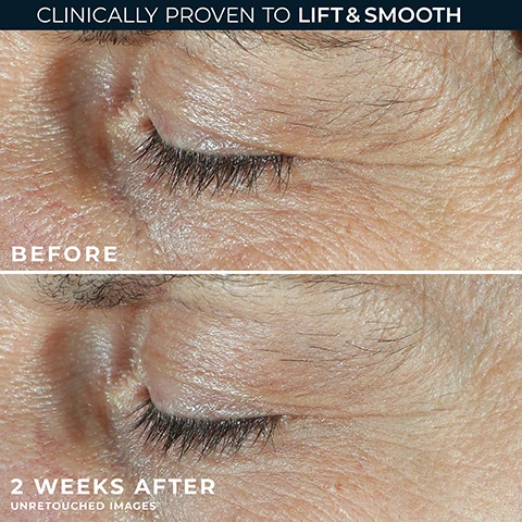Image 1 - A before and after comparison image of a persons eye area shows a top section with visible wrinkles labeled BEFORE, and a bottom section with noticeably smoother skin labeled 2 WEEKS AFTER, with the text CLINICALLY PROVEN TO LIFT & SMOOTH at the top and UNRETOUCHED IMAGES at the bottom. Image 2 - An open jar of RoC Derm Corrextion Dual Eye Cream revealing a translucent orange gel and white cream is shown above two closed stacked jars of the same product, with text stating 90% SAW EYELIDS VISIBLY LIFTED, 96% SAW VISIBLY REDUCED LINES, CLINICALLY PROVEN, and the jar labels read RoC CLINICALLY PROVEN + DERM CORREXION DUAL EYE CREAM + ADVANCED RETINOL + PEPTIDES 2X 0.34 FL. OZ. (10 ML). Image 3 - A black and white portrait of a smiling man wearing glasses is shown against a textured brown background, with white text reading Board-Certified Dermatologist Dr. Guo and A revolutionary way to target the entire eye area - that delivers visible results. Image 4 - A two-panel image showing a golden-yellow liquid with bubbles on the left and a light blue-grey liquid with bubbles on the right, featuring text RoC® RETINOL VISIBLY REDUCES WRINKLES PEPTIDES VISIBLY FIRM + LIFT. Image 5 - A close-up of a persons face shows an eye and a hand holding a jar containing white cream and a brown liquid, with text that reads DOUBLE DOWN ON EYE TREATMENT VISIBLY LIFT & SMOOTH.