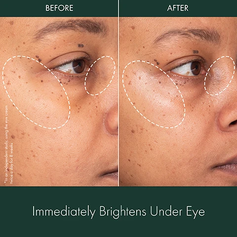 Image 1 - Side-by-side comparison of a persons under-eye area showing before and after results, with the left side labeled Before and the right side labeled After, and the text below stating Immediately Brightens Under Eye.
Image 2 - Image showing a split view of a persons face labeled BEFORE on the left with visible dark circles under the eye, and AFTER on the right with less visible dark circles; visible text states 94% agree dark circles are less visible.
Image 3 - Before and after images showing the eyes of a woman, with the top section labeled Before and the bottom section labeled After 4 Weeks, along with text stating 94% agree dark circles are less visible and a note about an independent study using the eye cream twice a day for 8 weeks.
Image 4 - Image comparing the appearance of a persons under-eye area before and after treatment, with the left side labeled BEFORE showing pronounced dark circles, and the right side labeled AFTER showing improved brightness and reduced dark circles; the text at the bottom states 94% agree dark circles are less visible.
Image 5 - A close-up of a brightening eye cream bottle on a soft background with an orange slice, featuring the text CLINICALLY PROVEN RESULTS Immediately brightens under eye After 4 Weeks: 94% agree dark circles are less visible 94% showed visible reduction in under eye lines -29% reduction in under eye lines at the top and bottom.