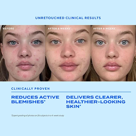 Image 1 - Three photos show a womans face from the nose up before, after 6 weeks, and after 8 weeks, illustrating reduced blemishes, with text that reads Unretouched Clinical Results, Before, After 6 Weeks*, After 8 Weeks*, Clinically Proven, Reduces Active Blemishes*, Delivers Clearer, Healthier-Looking Skin*, Expert grading of photos on 26 subjects in a 4-week study. Image 2 - Before and after clinical result photos show skin improvement over 4 weeks, with text UNRETOUCHED CLINICAL RESULTS, BEFORE, AFTER 3 DAYS*, AFTER 4 WEEKS*, CLINICALLY PROVEN, CLEARER SKIN STARTS IN JUST 3 DAYS*, and *Consumer testing on 26 subjects in a 4-week study. Image 3 - A close-up of a persons face with labels pointing to different areas representing blemishes including text labels Pimples, Blemishes, Whiteheads, Blackheads, and Hormonal surrounding a central circle with the text CLEARS ALL TYPES OF BLEMISHES. Image 4 - An infographic lists four ingredients and their benefits: Mandelic Acid Smooths + evens the complexion, Biome-Sensing Tech Balances the microbiome to naturally resist recurring blemishes, Salicylic Acid Rapidly treats + prevents breakouts—from whiteheads to hormonal, Glutamic Acid Feeds the skins microbiome for healthier-looking skin. Image 5 - A Murad Blemish Control serum bottle is shown with the text DONT JUST TREAT BLEMISHES. HELP KEEP THEM FROM COMING BACK, followed by bullet points Clears all types of blemishes fast, Decongests clogged pores, Delivers smoother, healthier-looking skin, Balances the microbiome to naturally resist recurring blemishes, and bottle label text Murad. BLEMISH CONTROL Biome-Balancing Clear & Prevent Blemish Treatment Serum Sérum de traitement bio-équilibrant pour le nettoyage et la prévention des imperfections. Image 6 - Image shows a four-step Murad blemish control routine with text HOW TO ADD BLEMISH SERUM TO YOUR ROUTINE, STEP 1 CLEANSE Clarifying Cleanser, STEP 2 TREAT Clear & Prevent Blemish Serum, STEP 3 MOISTURISE + SPF Superactive Mattifying Oil + Pore Control SPF 40, STEP 4 TREAT Deep Relief Blemish Treatment, and icons for Blemish Serum and Deep Relief Blemish Treatment. Image 7 - Image shows a bottle of Murad Blemish Control Biome-Balancing Clear & Prevent Blemish Treatment Serum alongside text reading NO UNWANTED SIDE EFFECTS: 92% AGREE* NO PEELING FLAKING REDNESS IRRITATION + non-comedogenic and layers well under makeup. *Consumer testing on 26 subjects in a 4-week study. Image 8 - Image showing a bottle of Murad Biome-Balancing Clear & Prevent Blemish Treatment Serum with text label Murad BLEMISH CONTROL Biome-Balancing Clear & Prevent Blemish Treatment Serum Sérum de traitement bio-équilibrant pour le nettoyage et la prévention des imperfections next to large text reading BIOME-BALANCING CLEAR & PREVENT BLEMISH TREATMENT SERUM Clears blemishes, prevents future breakouts, and promotes a healthy, balanced complexion on a blue background. Image 9 - A smiling woman with freckles holds a blue bottle of Murad Biome-Balancing Clear & Prevent Blemish Treatment Serum which has the text Murad. BLEMISH CONTROL Biome-Balancing Clear & Prevent Blemish Treatment Serum Sérum de traitement bio-équilibrant pour le nettoyage et la prévention des imperfections on it, with the large text LIKE BALANCED GUT HEALTH, BUT FOR SKIN also visible.