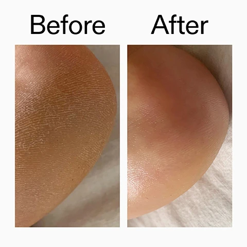 Image 1 - A split image shows a dry, cracked heel on the left and a smooth, moisturized heel on the right, with the text Before After. Image 2 - A before and after comparison of skin, showing a left panel with noticeable bumps and redness, labeled Before, and a right panel with significantly smoother skin and fewer bumps, labeled After. Image 3 - A smiling person with clear, glowing skin on their forehead, accompanied by text that reads: Clinically proven to reduce the appearance of roughness and bumps*, Glides on dry or damp skin - no mess, no sting, Improves overall skin texture and moisture levels, *4-week consumer study of 100 people. Image 4 - A woman with dark hair and glowing skin wearing a white tank top looks at the camera, with a tattoo on her shoulder reading But to the entire, followed by the text Why we love PHA Body Water Cream, Exfoliates and hydrates in one step, Fast-absorbing, non-sticky, and Brightens and evens skin tone. Image 5 - A person with dark skin holds a white and black product stick labeled THE inkey LIST GLYCOLIC ACID EXFOLIATING BODY STICK Net Wt. 1.76 oz (US) / 50g e against their shoulder. Image 6 - A close-up of white creamy product textures provides instructions on How to layer Smooth & Glow Body Duo: 1 Glycolic Acid Exfoliating Body Stick SWIPE DIRECTLY ONTO CLEAN, DRY SKIN IN AREAS NEEDING EXFOLIATION. USE 2-3 TIMES PER WEEK OR AS NEEDED. 2 PHA Body Water Cream APPLY DAILY TO CLEAN, DRY SKIN ALL OVER THE BODY. ALWAYS FOLLOW WITH SPF IF EXPOSING TREATED AREAS TO THE SUN.
