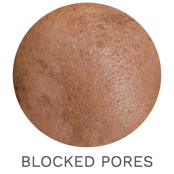 BLOCKED PORES