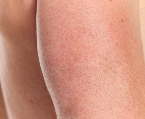 Ameliorate for Keratosis Pilaris